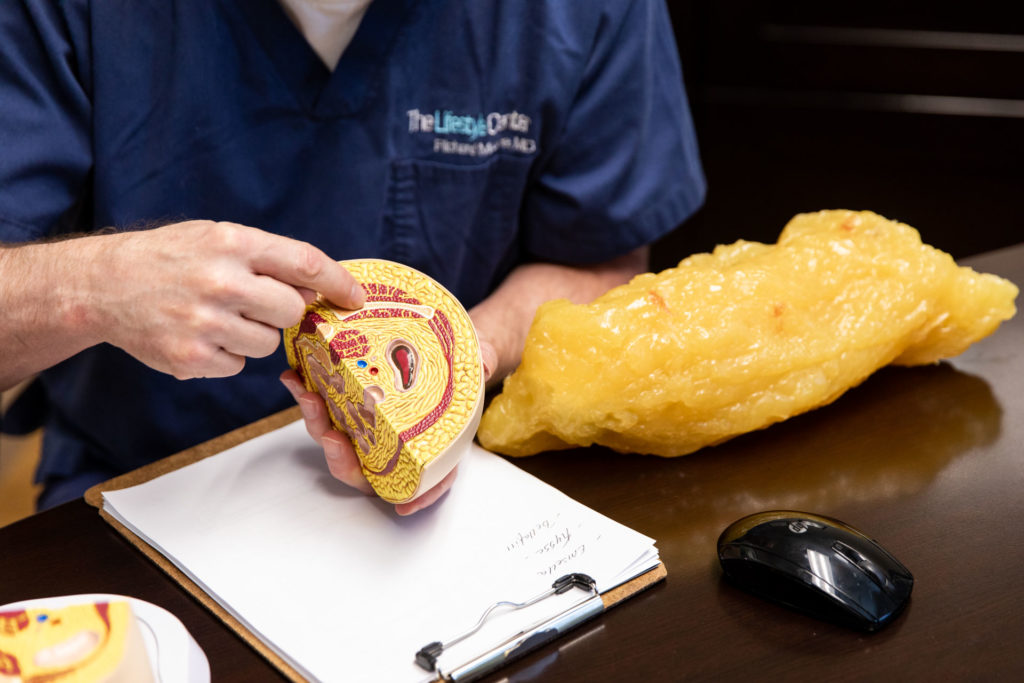 Male Doctor holding a model of a body part relating to tickle lipo procedure